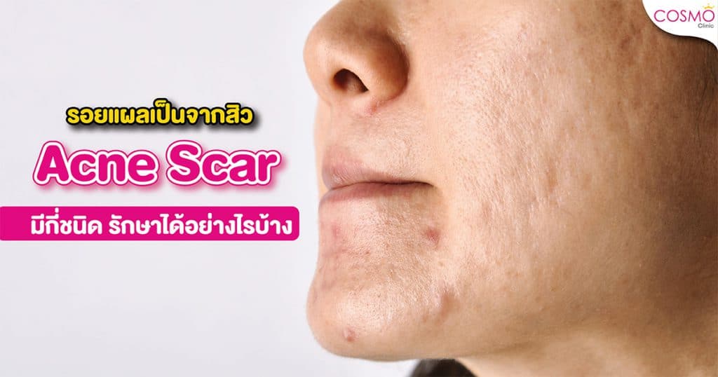 Acne-scar