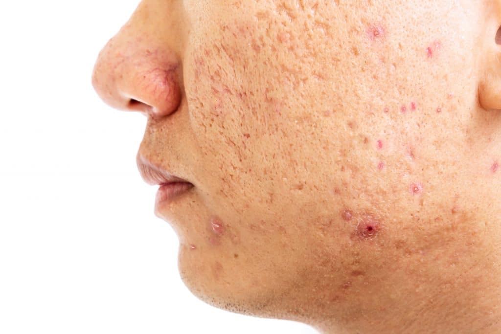 close-up-problematic-skin-with-deep-acne-scars-cheek-men-pigmentation