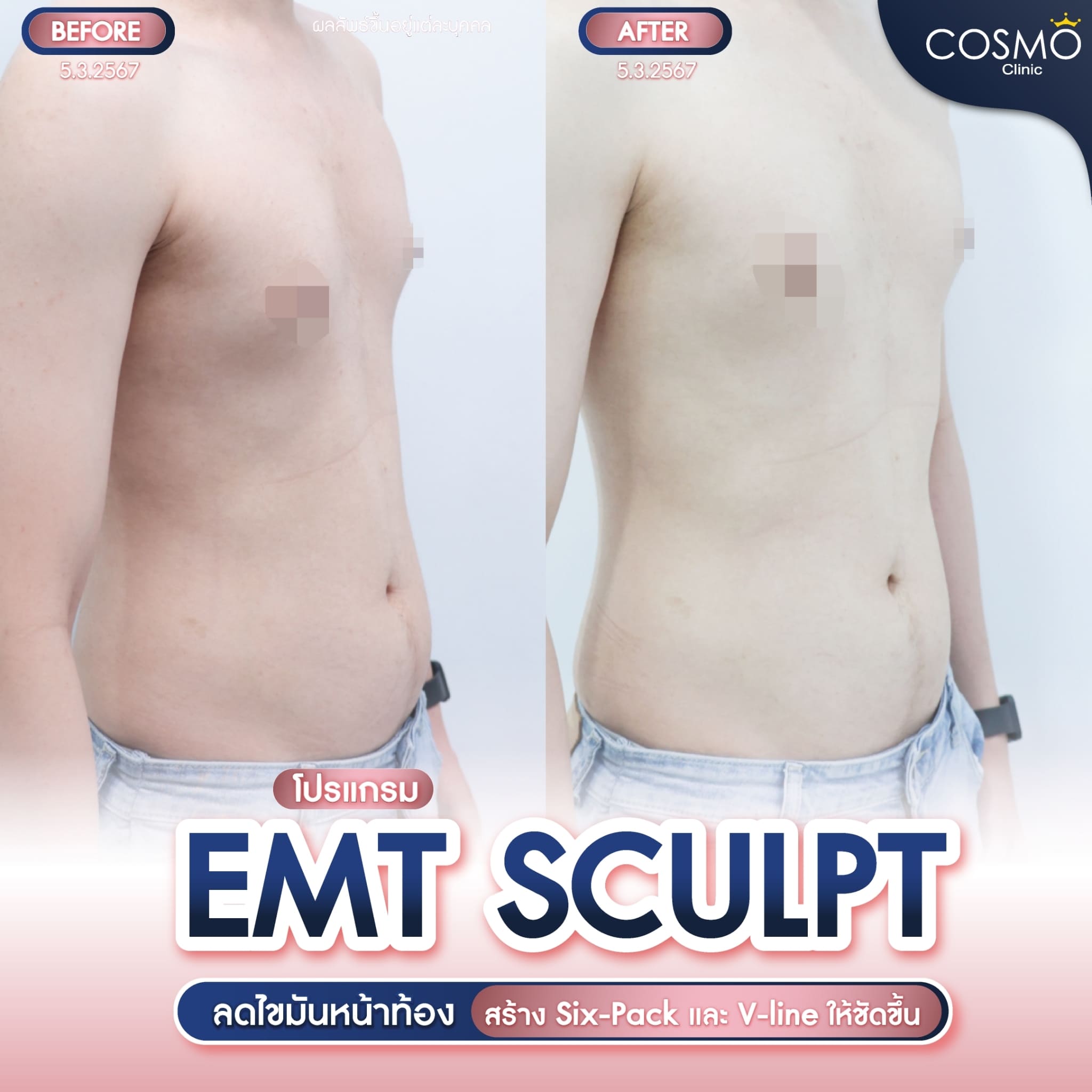 emsculpt