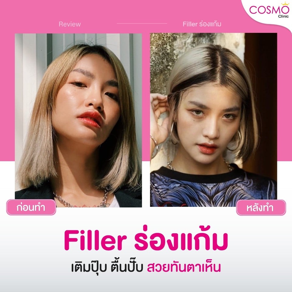 รีวิว-filler-ร่องแก้ม