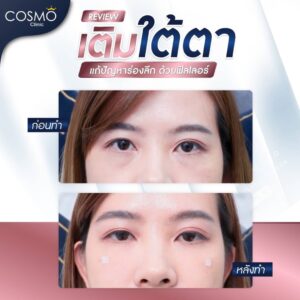 ฉีดฟิลเลอร์ใต้ตา 1cc