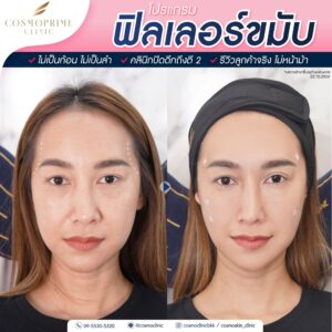 รีวิวฉีดฟิลเลอร์ขมับ