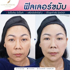 ข้อปฏิบัติหลังฉีด filler ขมับ