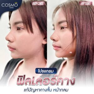 ฟิลเลอร์คาง 1 cc ราคา