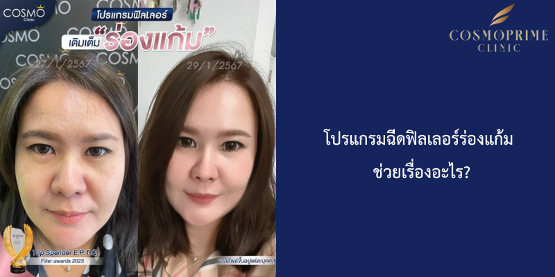 โปรแกรมฉีดฟิลเลอร์ร่องแก้ม ช่วยเรื่องอะไร?