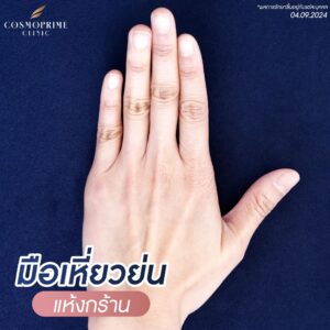 ฟิลเลอร์มือราคา