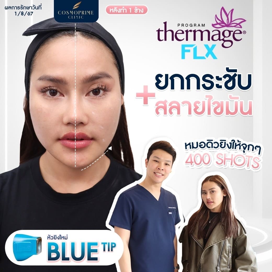 thermage flx คือ